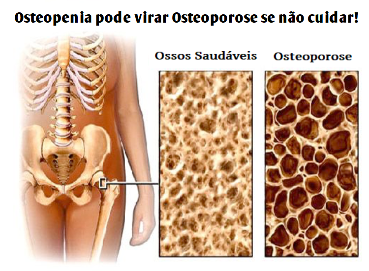 osteopenia o que é